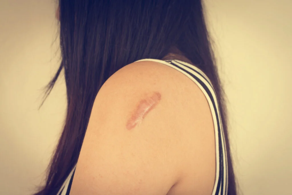 What Is the Best Scar Treatment? Types, Procedures, Results and Recovery Guide