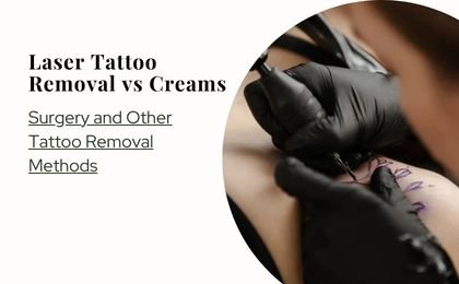 Laser Tattoo Removal vs Creams, Surgery and Other Tattoo Removal Methods