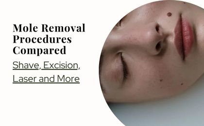 Mole Removal Procedures Compared—Shave, Excision, Laser and More