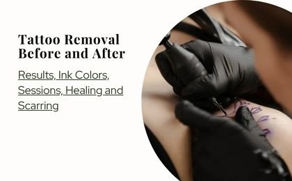 Tattoo Removal Before and After—Results, Ink Colors, Sessions, Healing and Scarring