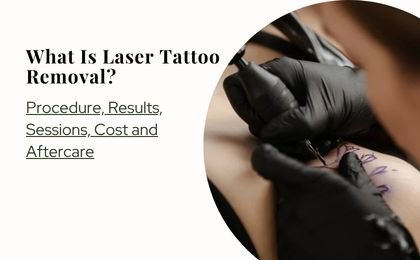 What Is Laser Tattoo Removal? Procedure, Results, Sessions, Cost and Aftercare